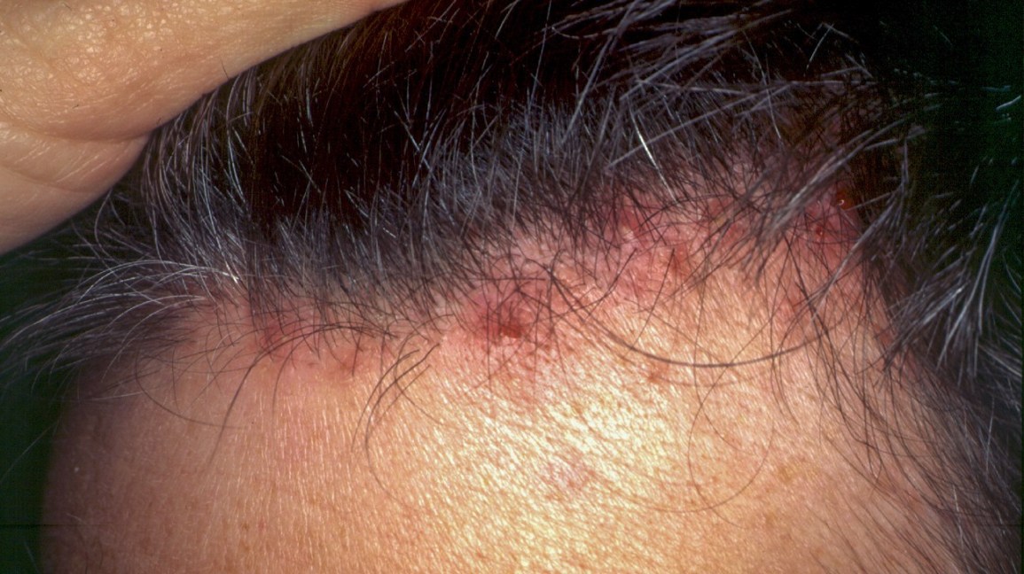 scalp folliculitis