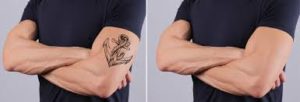 tatoo removal treatments in pune