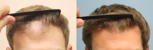 Hair transplant cost