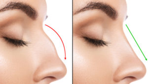 nose reshaping in pune