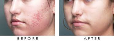 Acne Scar Treatment Pune