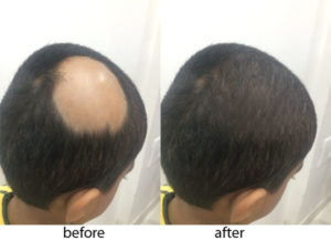 Alopecia Areata Hair Loss Treatment Pune