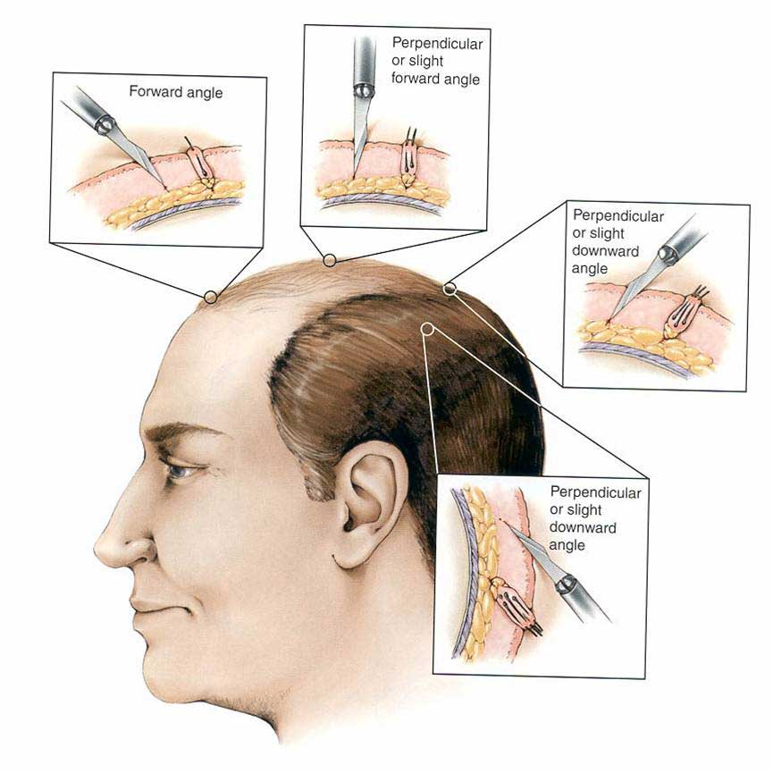 hair transplant pune