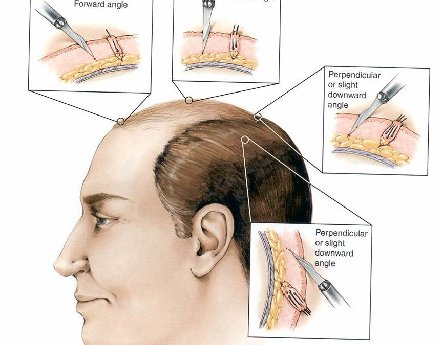 The hair transplant starts growing after 4 months and is permanent