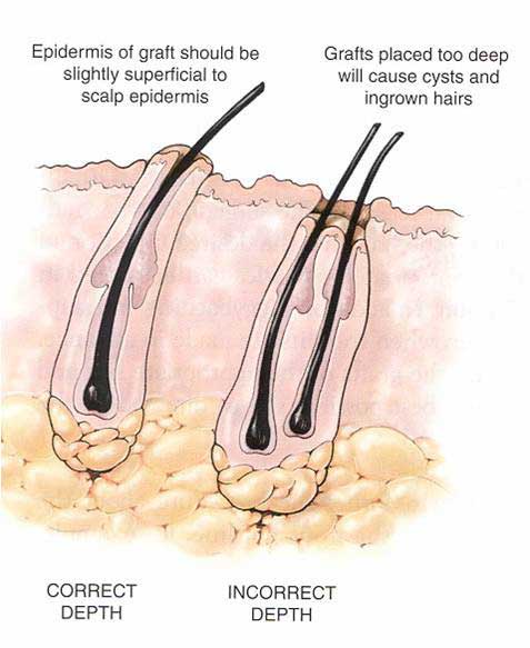 hair transplant pune