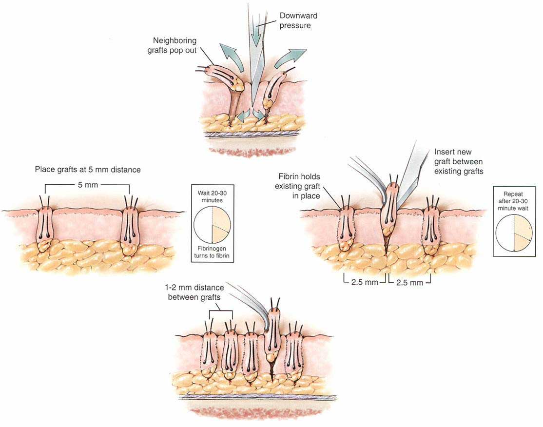 hair transplant pune