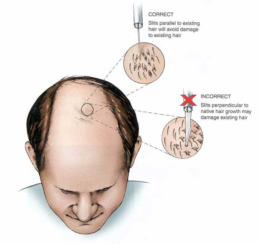 hair transplant pune