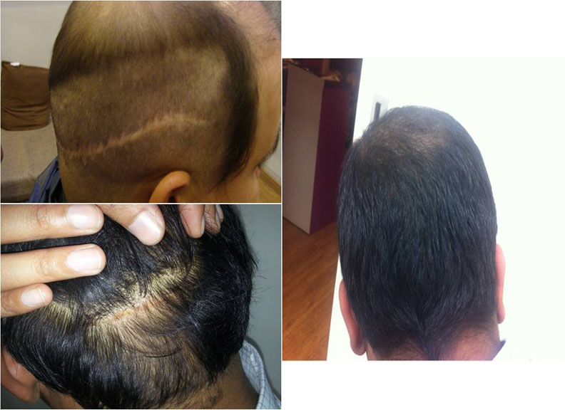 FUE Hair Transplant Pune | Hair Transplant | Hair Restoration | FUE pune