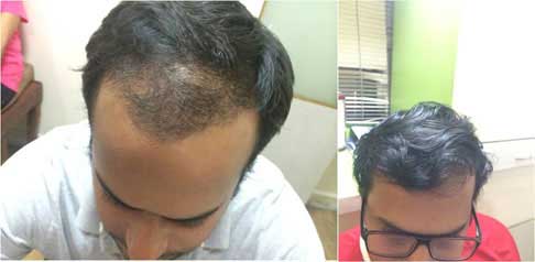 Hair Loss Treatment | Hair Baldness Treatment at Skin & surgery