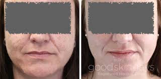 Anti Ageing Treatment Pune - Skin and Surgery International