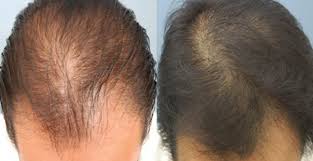 PRP Hair Therapy and Treatments