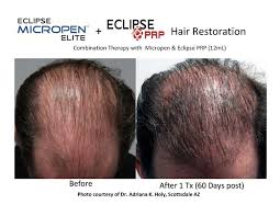 PRP Hair Therapy and Treatments (Platelet Rich Plasma)