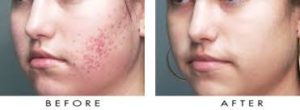 Acne Scar Treatment before and after