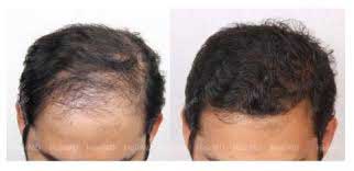 Hair-Baldness-Treatment