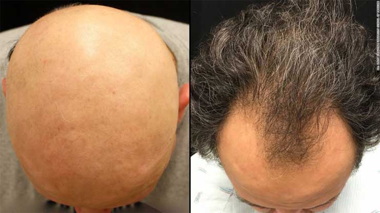 alopecia-areata