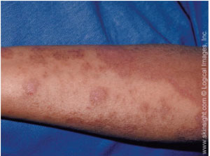 atopic-dermatitis