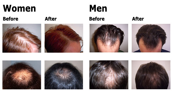hair baldness treatment